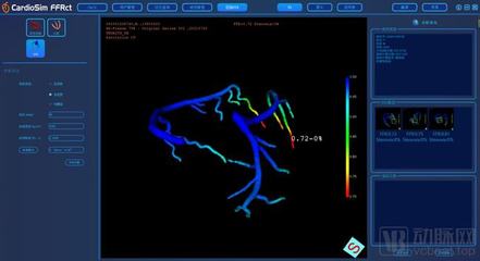 生物流體力學(xué)賦能精準(zhǔn)醫(yī)療，晟視科技近億元Pre-A輪融資引領(lǐng)超聲技術(shù)創(chuàng)新
